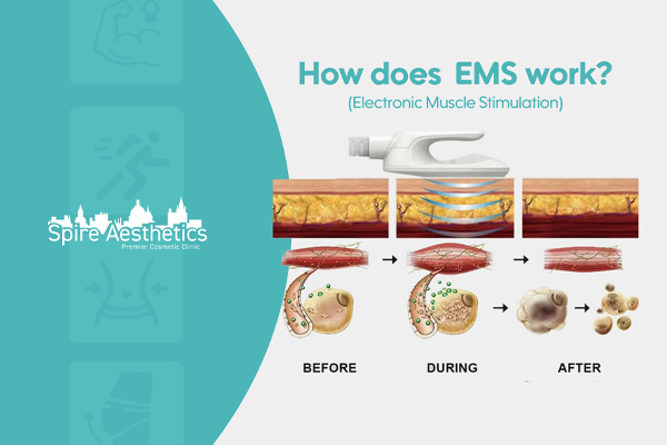 EMS treatment for post pregnancy weight loss treatment Harrow