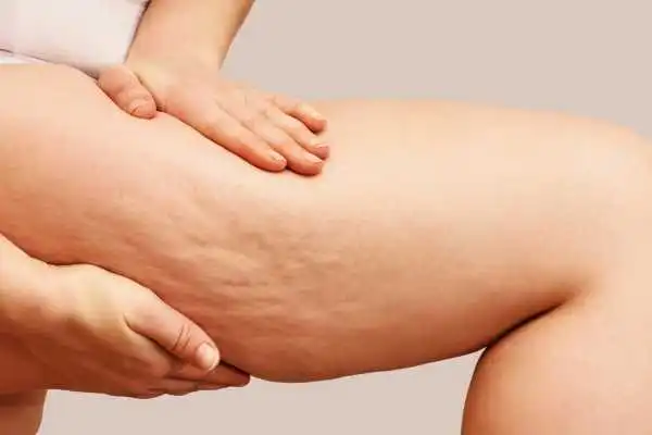 Image of woman showing leg with cellulite Harrow