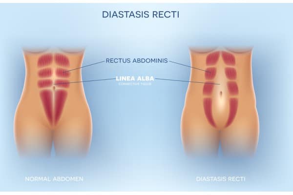 What Non-Surgical Options Are Available for Diastasis Recti Harrow?