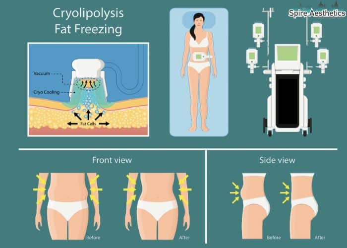 Image of diet and fat freezing combined for best results for Spire Aesthetics Harrow