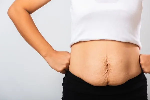 Image of a woman's stomach after weight loss with sagging skin following a gastric band Harrow