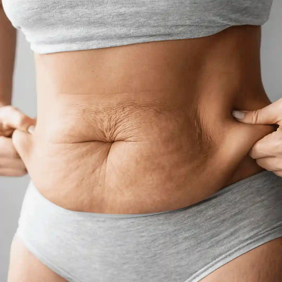 Is It Normal to Have Loose Skin After Pregnancy Harrow?