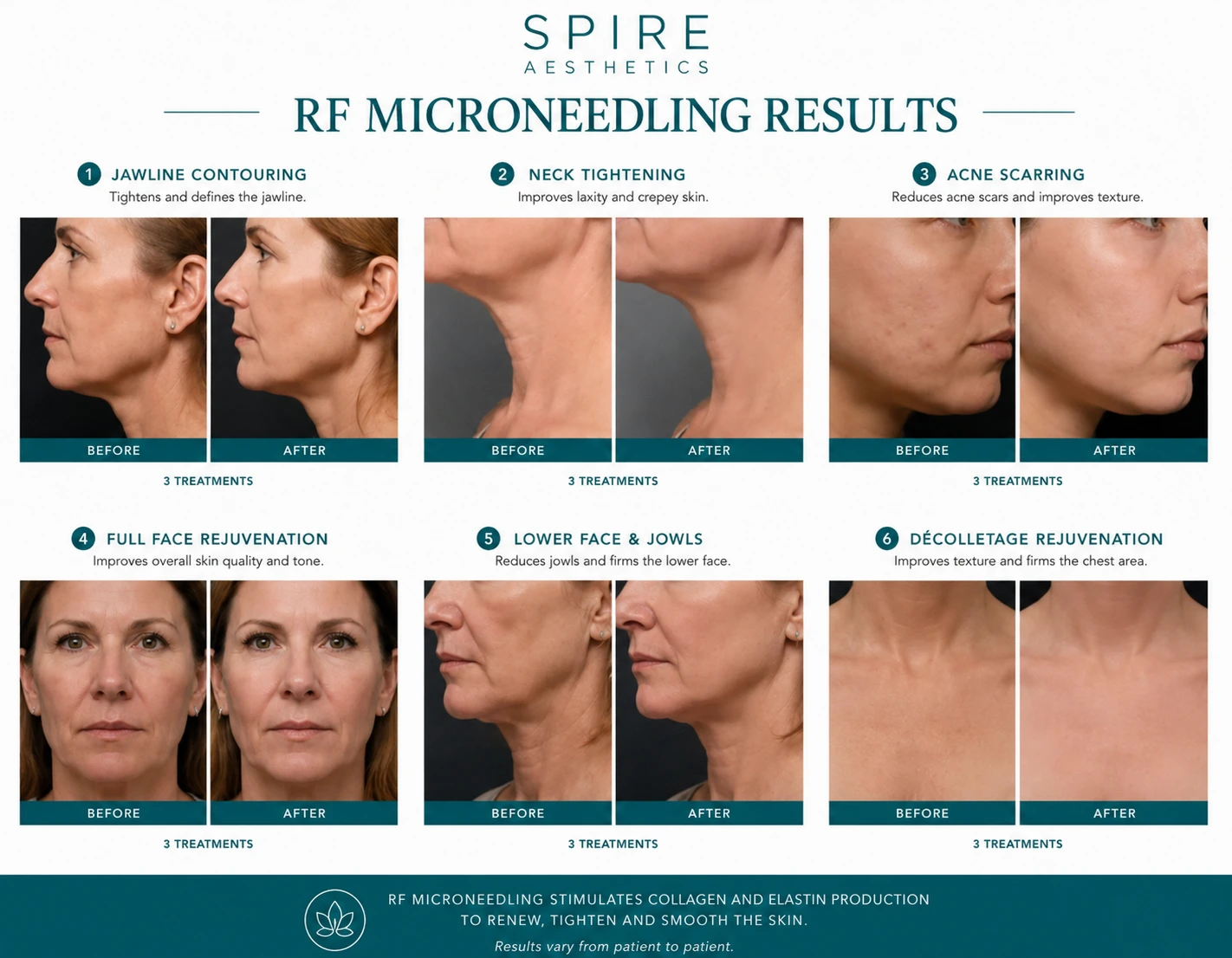 RF Microneedling Skin tightening Harrow results