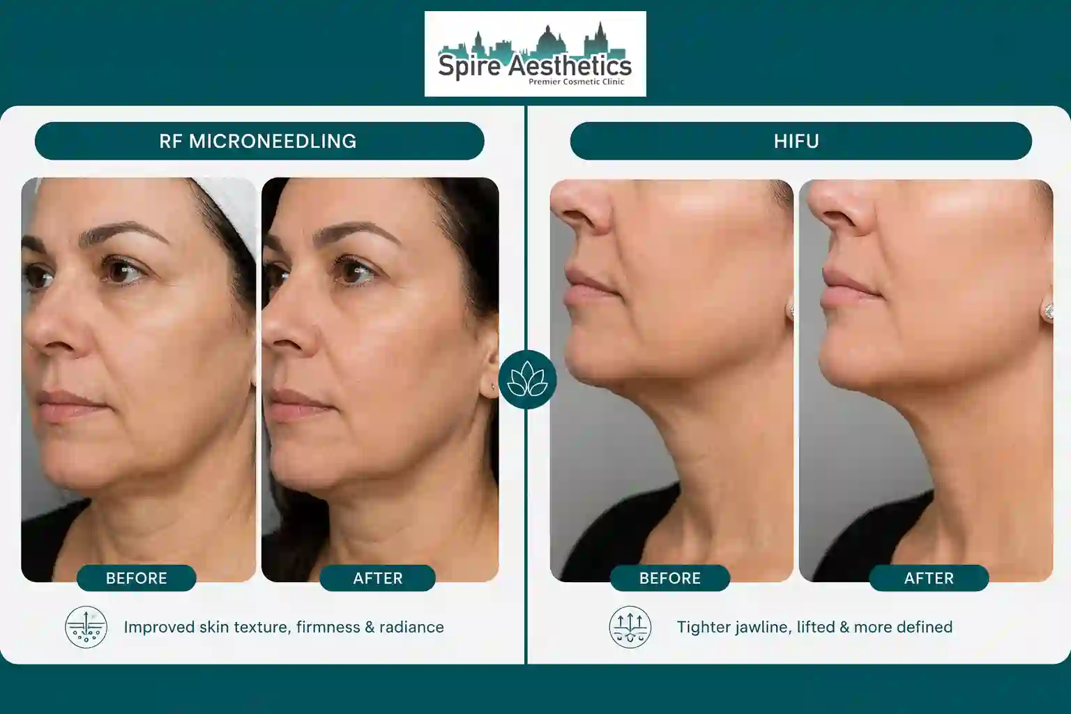 Can RF Microneedling and HIFU Be Combined Harrow?