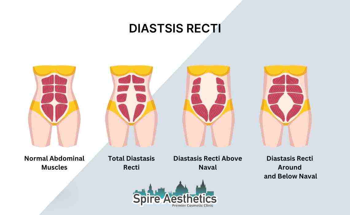 Is Non-Surgical Diastasis Recti Treatment Right for You? Common Concerns Answered Harrow
